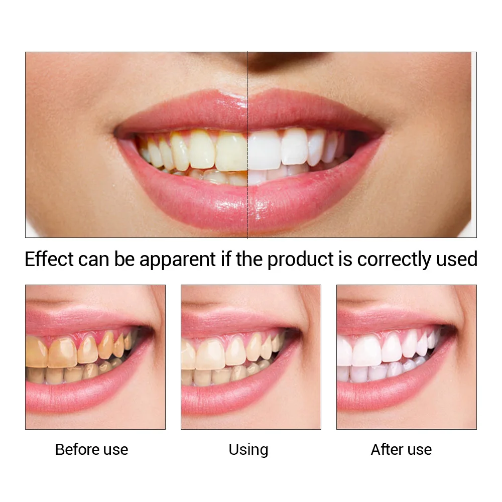 FTEENPLY Làm Trắng Răng Tinh C - đánh giá và giá Teeth Whitening At Home