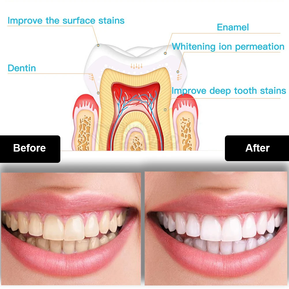 Dental Teeth Whitening Kit Min - đánh giá và giá Teeth Whitening At Home